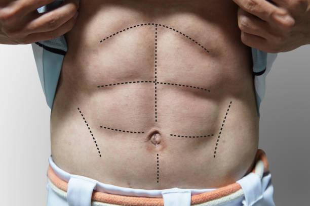 Abdominoplastia Invertida: Entenda os Benefícios Deste Procedimento Estético Inovador Abdominoplastia Invertida: Entenda os Benefícios Deste Procedimento Estético Inovador
