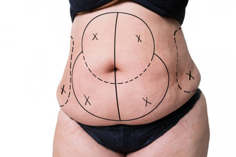 Abdominoplastia Agendar Boa Viagem - Abdominoplastia Circunferencial