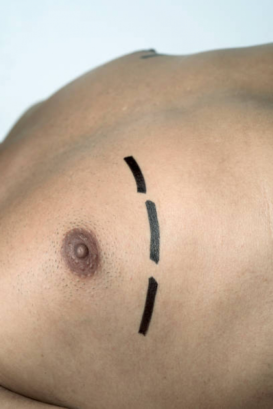Cirurgia da Mama Masculina Orçar Açailândia - Cirurgias de Ginecomastia