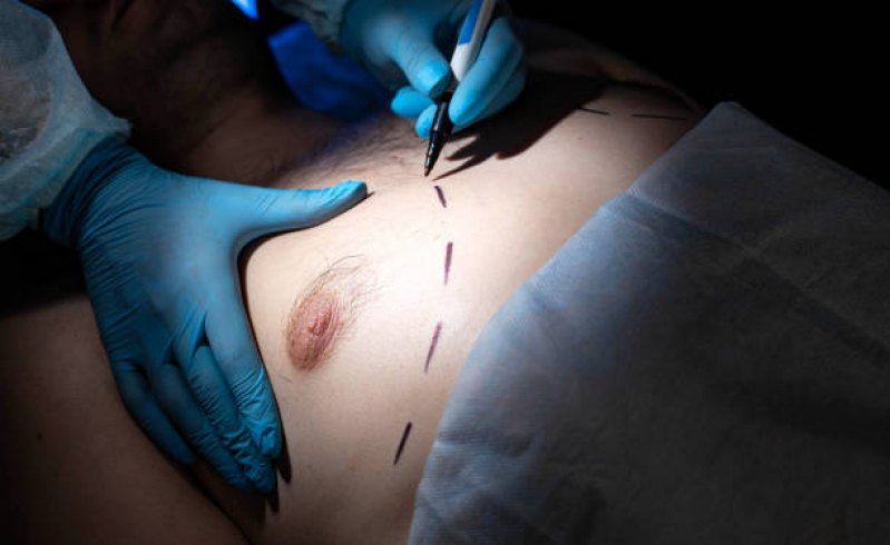 Cirurgia do Peitoral Masculino Corrente - Procedimento Peitoral Masculino