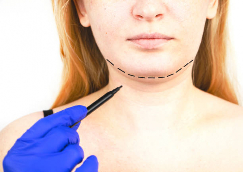 Cirurgia Mentoplastia Masculina Valor Zé Doca - Cirurgia do Queixo