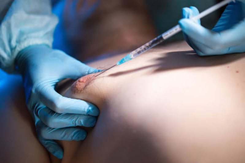 Cirurgia Peitoral Masculino Clinica Piripiri - Procedimentos de Peitoral Masculino