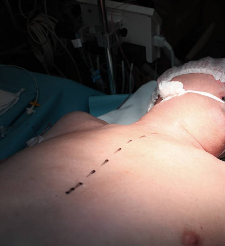 Cirurgia Peitoral Masculino Santa Filomena - Procedimento Peitoral Masculino