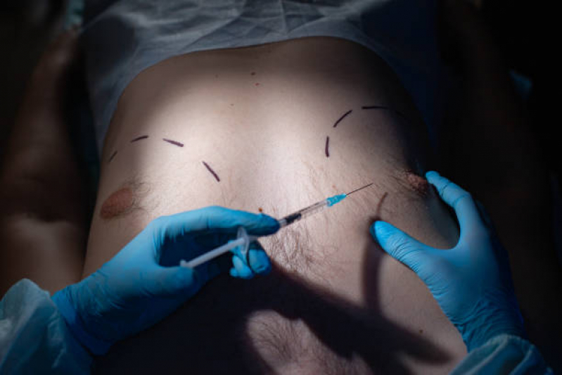 Cirurgias de Peitoral Masculino Clinica Marabá - Procedimentos Peitoral Masculino