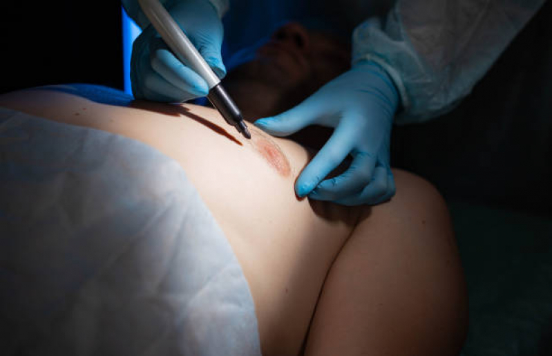 Cirurgias do Peitoral Masculino Clinica Paragominas - Procedimento Peitoral Masculino