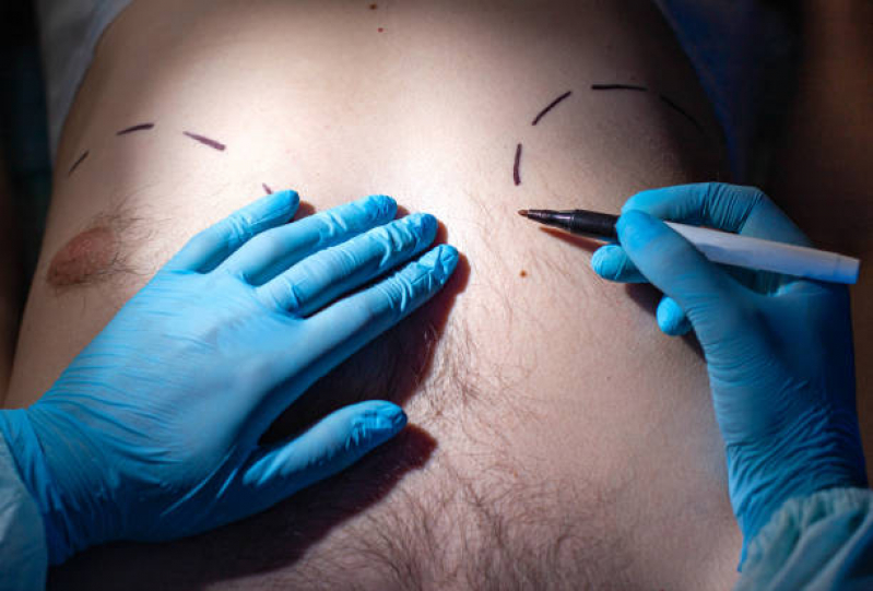 Cirurgias dos Peitorais Masculinos Clinica Carolina - Procedimento Peitoral Masculino