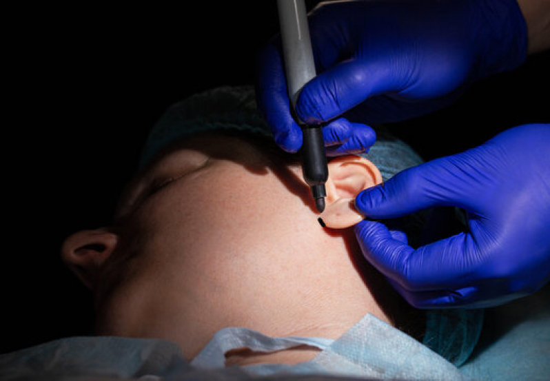 Clínica Que Faz Cirurgia de Redução de Orelha Bacabal - Cirurgia Lobuloplastia