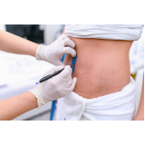 abdominoplastia invertida clínica Piracuruca