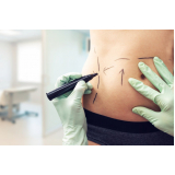 cirurgia lipoaspiração com enxerto de gordura Marabá