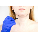 cirurgia mentoplastia masculina Estreito