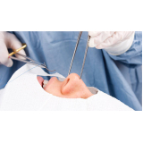 cirurgias de rinoplastia Redenção