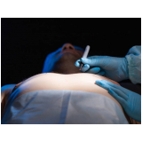 cirurgias ginecomastia masculina orçar Campos Sales