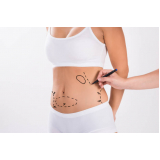 clínica especializada em mini abdominoplastia Pedreiras