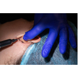 clinica para procedimentos de otoplastia Pacatuba